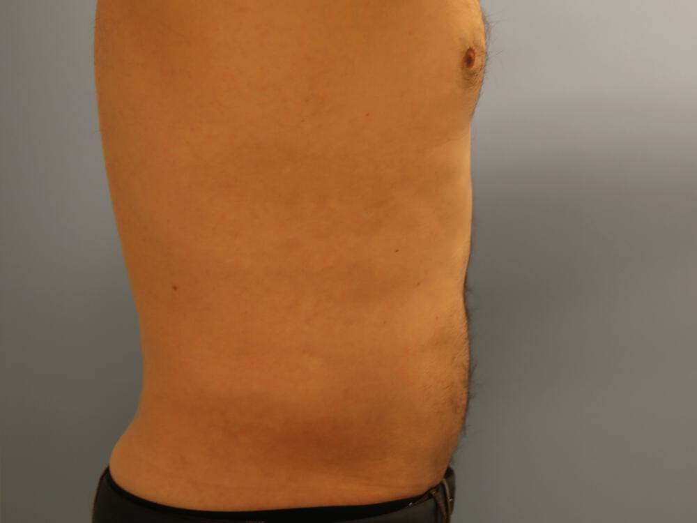Liposuction Before & After Image