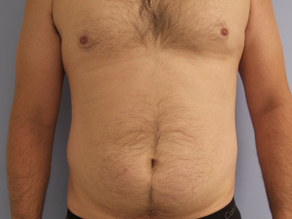 Liposuction Before & After Image
