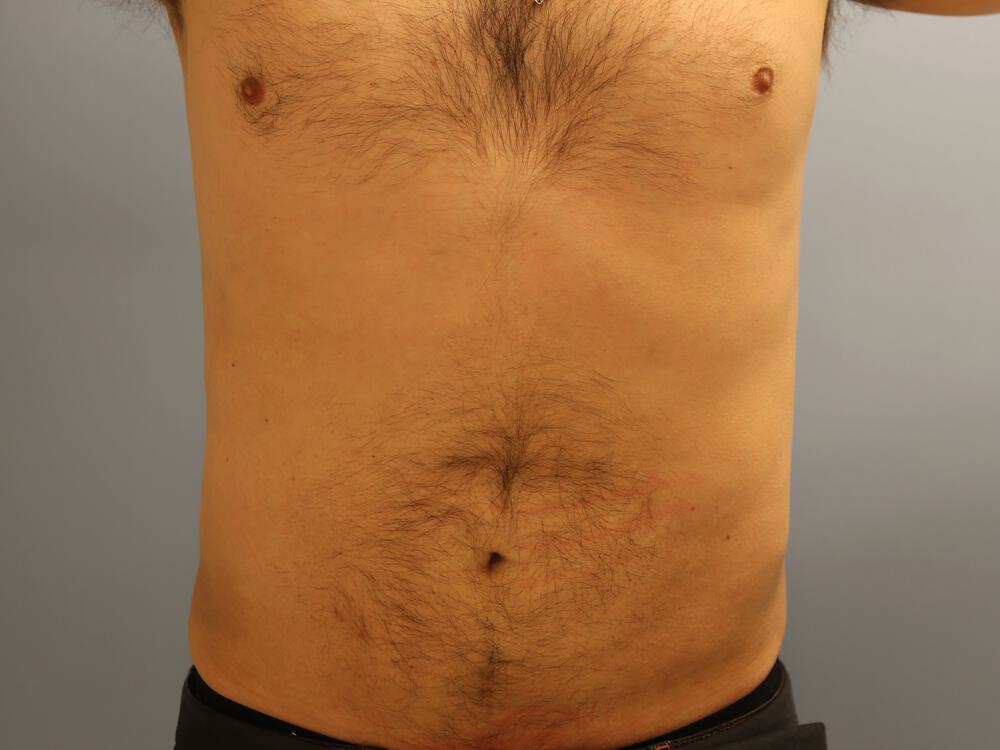 Liposuction Before & After Image