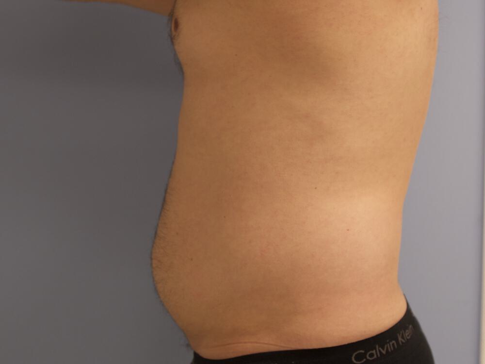 Male Liposuction Before & After Image