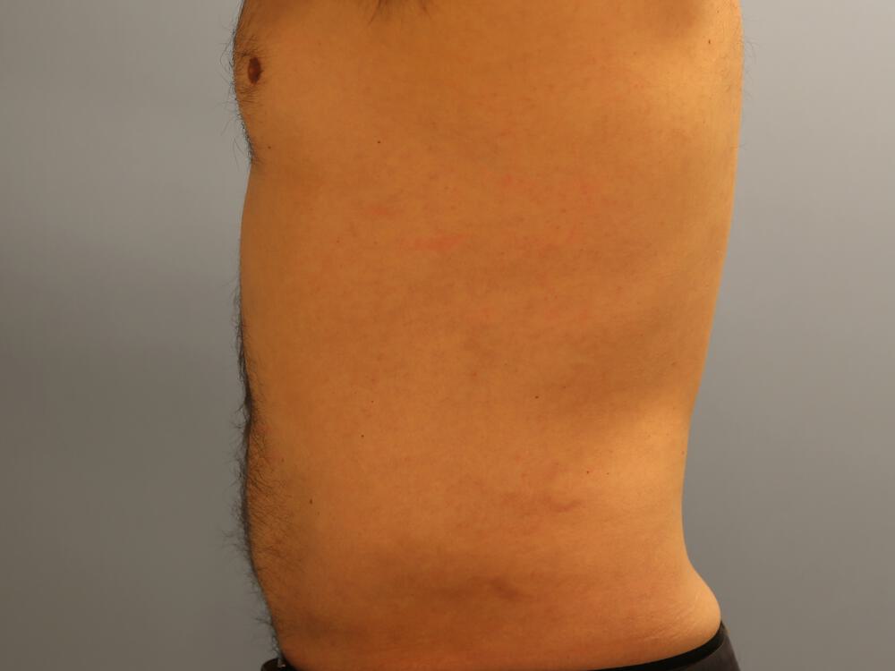 Male Liposuction Before & After Image