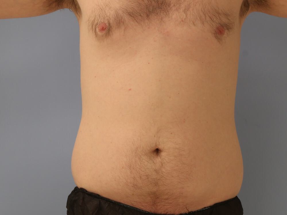 Liposuction Before & After Image