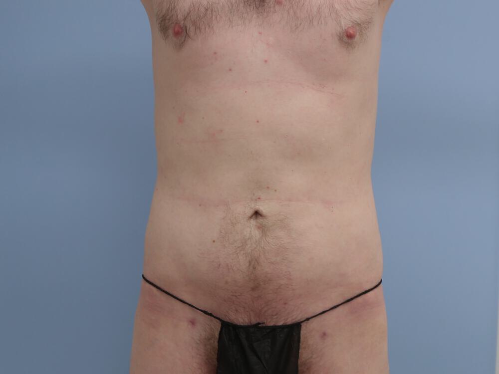 Liposuction Before & After Image