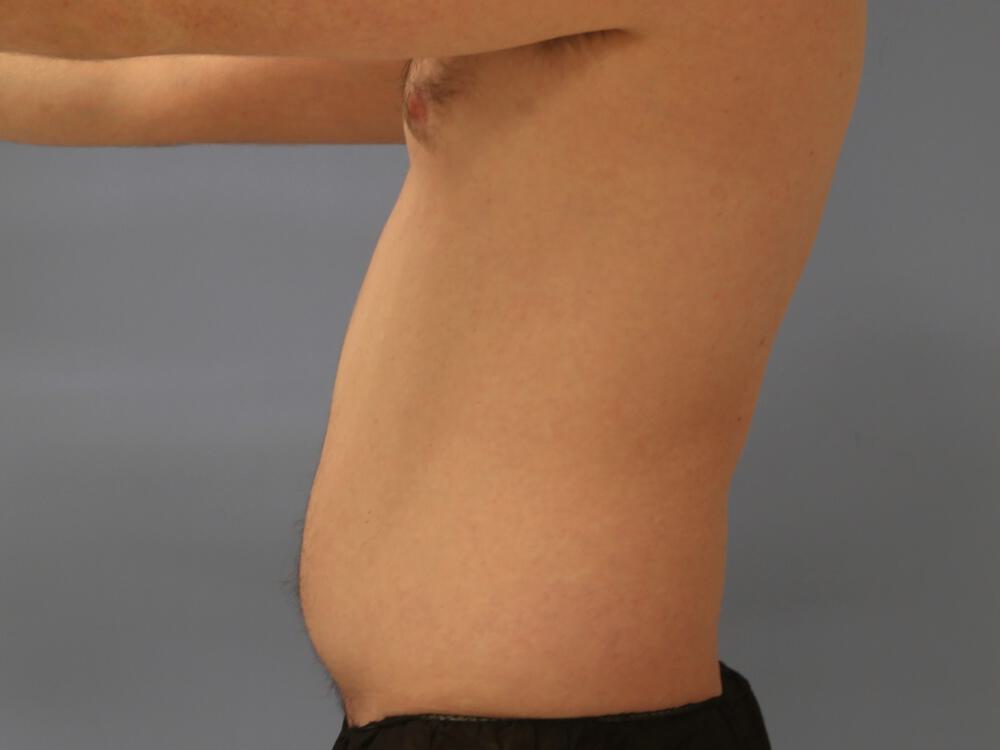 Male Liposuction Before & After Image