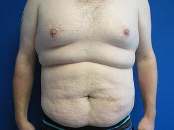 Male Tummy Tuck Before & After Image