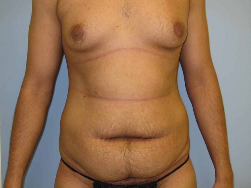 Male Tummy Tuck Before & After Image