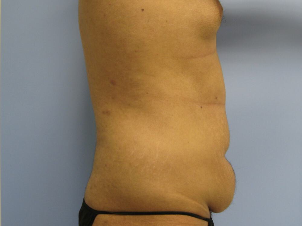 Male Tummy Tuck Before & After Image