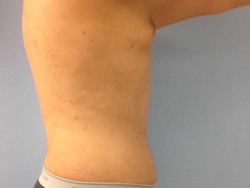 Male Tummy Tuck Before & After Image