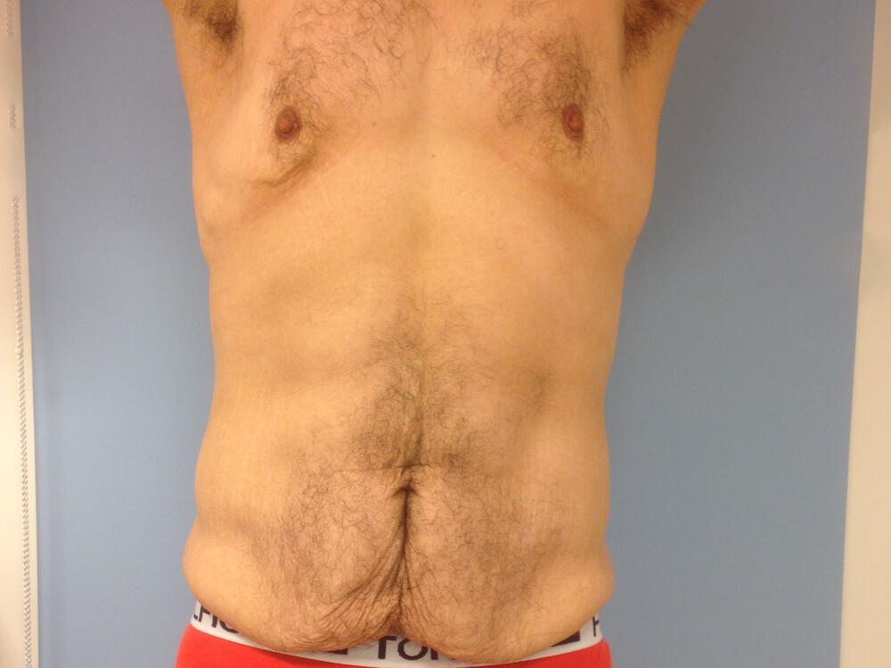 Male Tummy Tuck Before & After Image