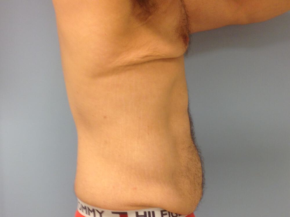 Male tummy tuck Before & After Image