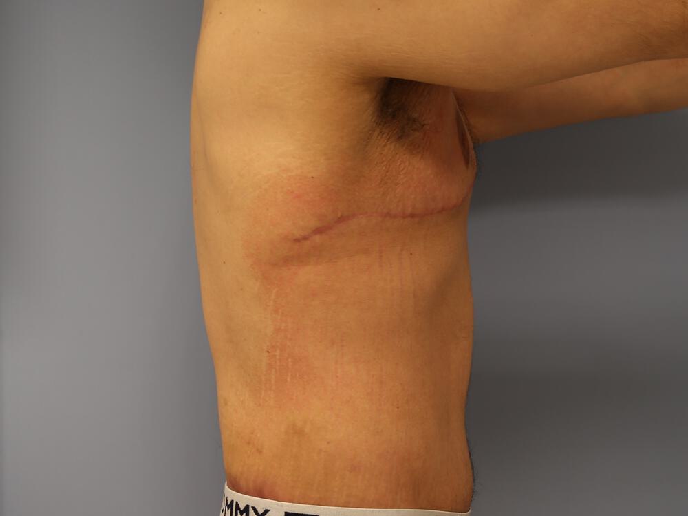 Male tummy tuck Before & After Image