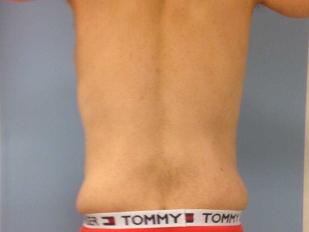 Male Tummy Tuck Before & After Image