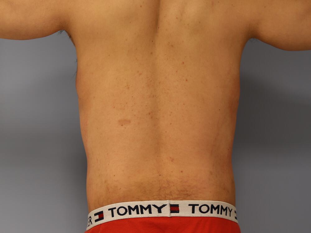 Male Tummy Tuck Before & After Image