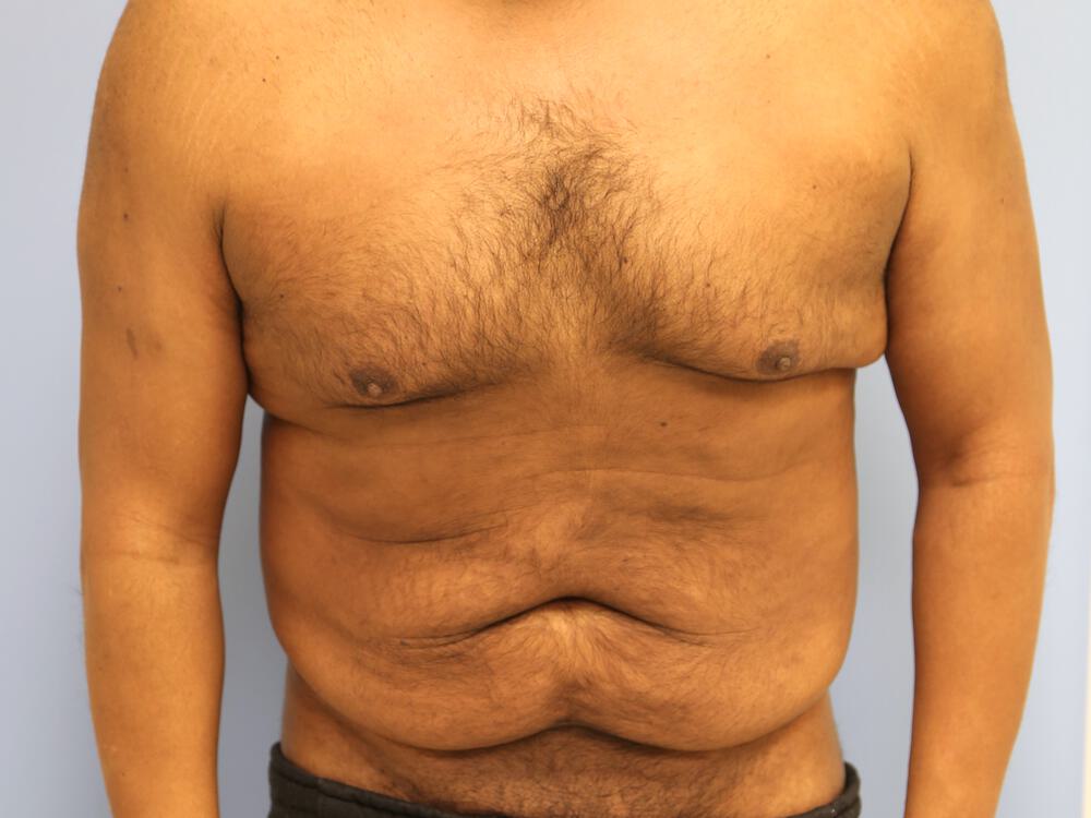 Male tummy tuck Before & After Image