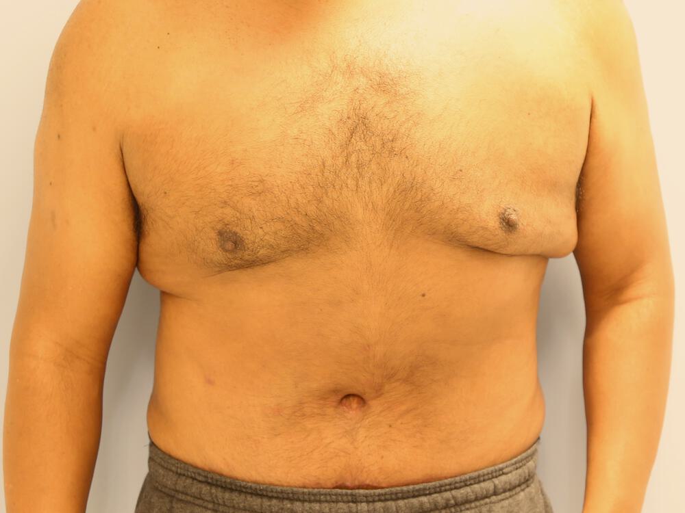 Male tummy tuck Before & After Image