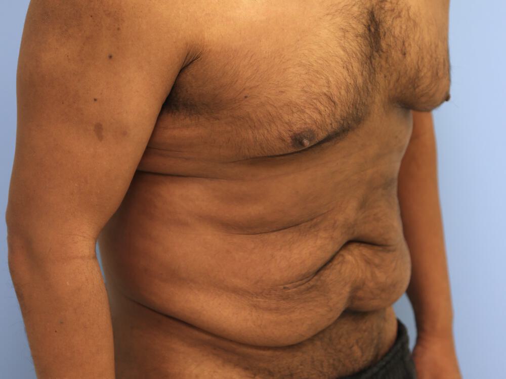 Male tummy tuck Before & After Image