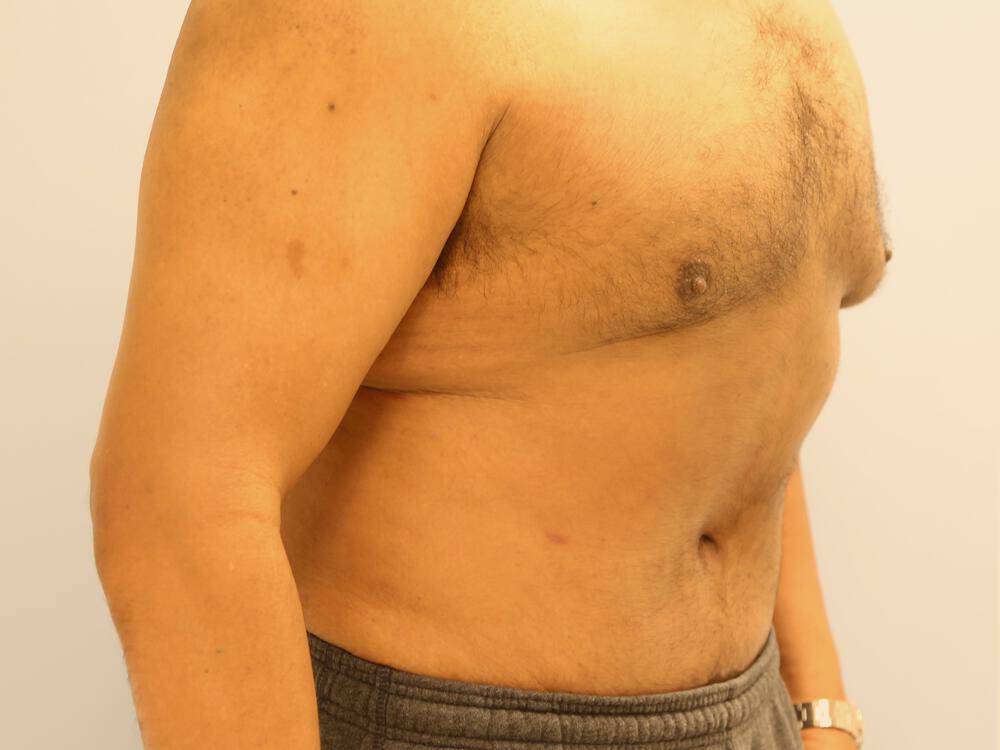 Male tummy tuck Before & After Image