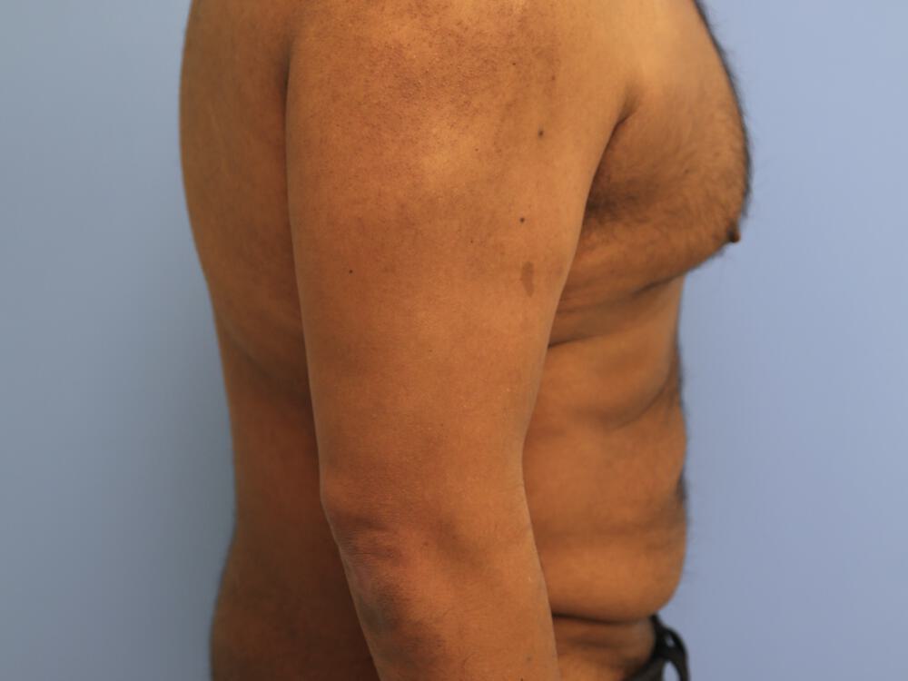 Male Tummy Tuck Before & After Image