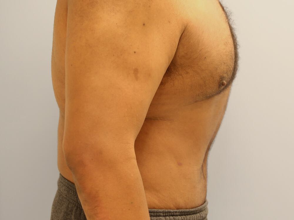 Male Tummy Tuck Before & After Image