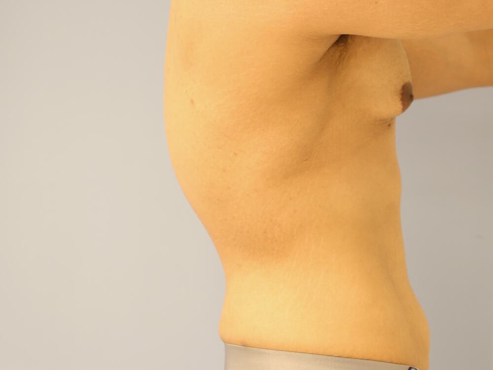 Male tummy tuck Before & After Image