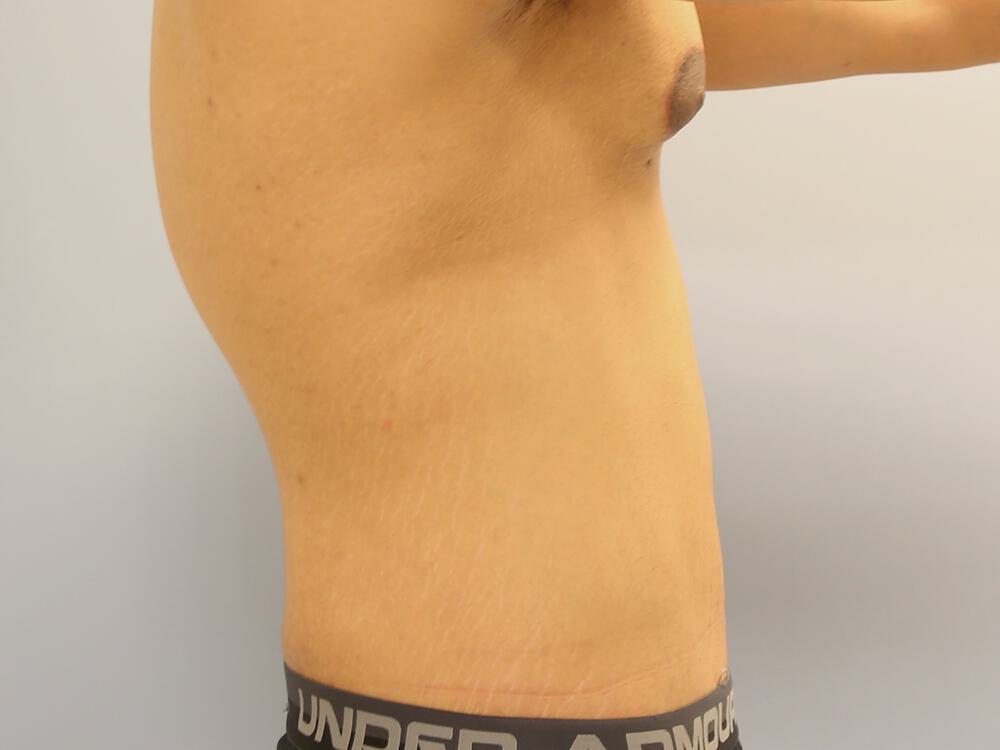 Male tummy tuck Before & After Image