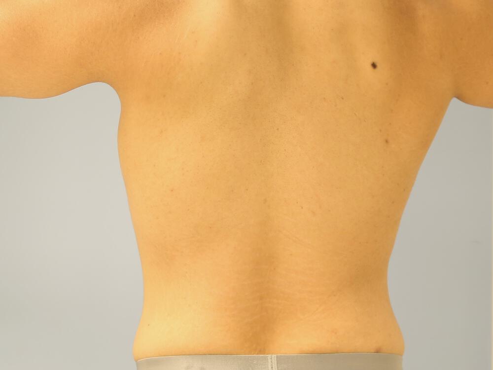 Male tummy tuck Before & After Image