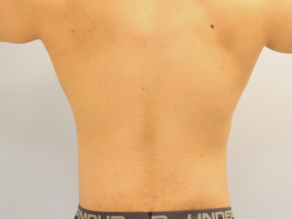 Male tummy tuck Before & After Image