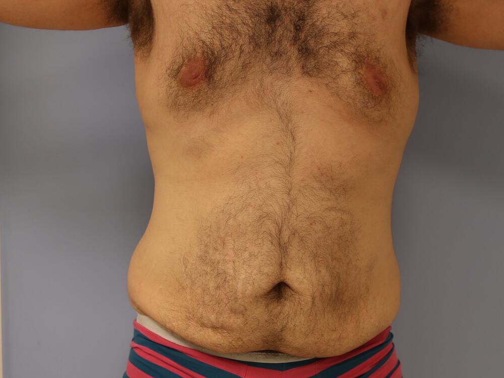 Male tummy tuck Before & After Image