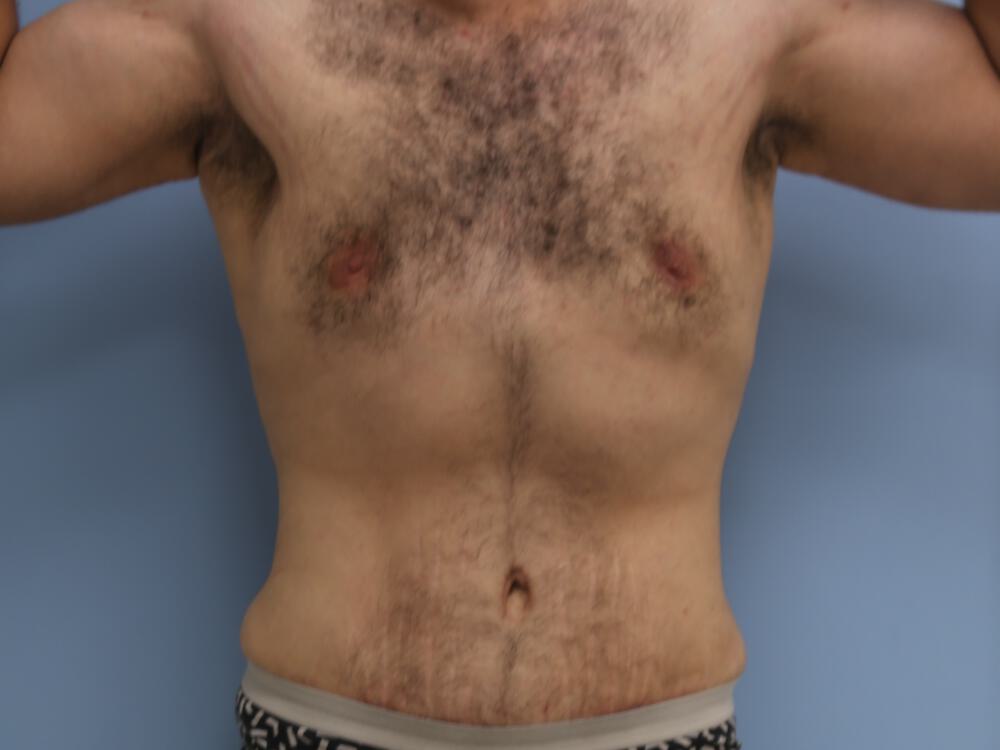 Male tummy tuck Before & After Image