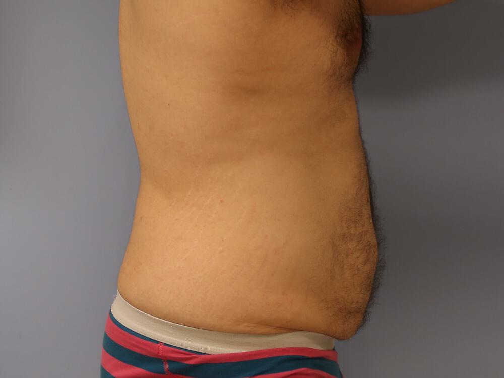 Male tummy tuck Before & After Image