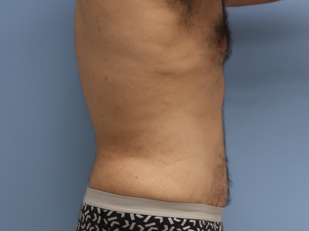 Male tummy tuck Before & After Image
