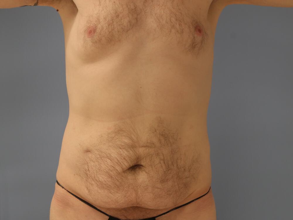 Male tummy tuck Before & After Image