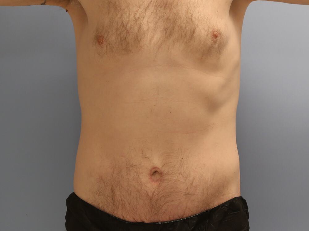 Male tummy tuck Before & After Image