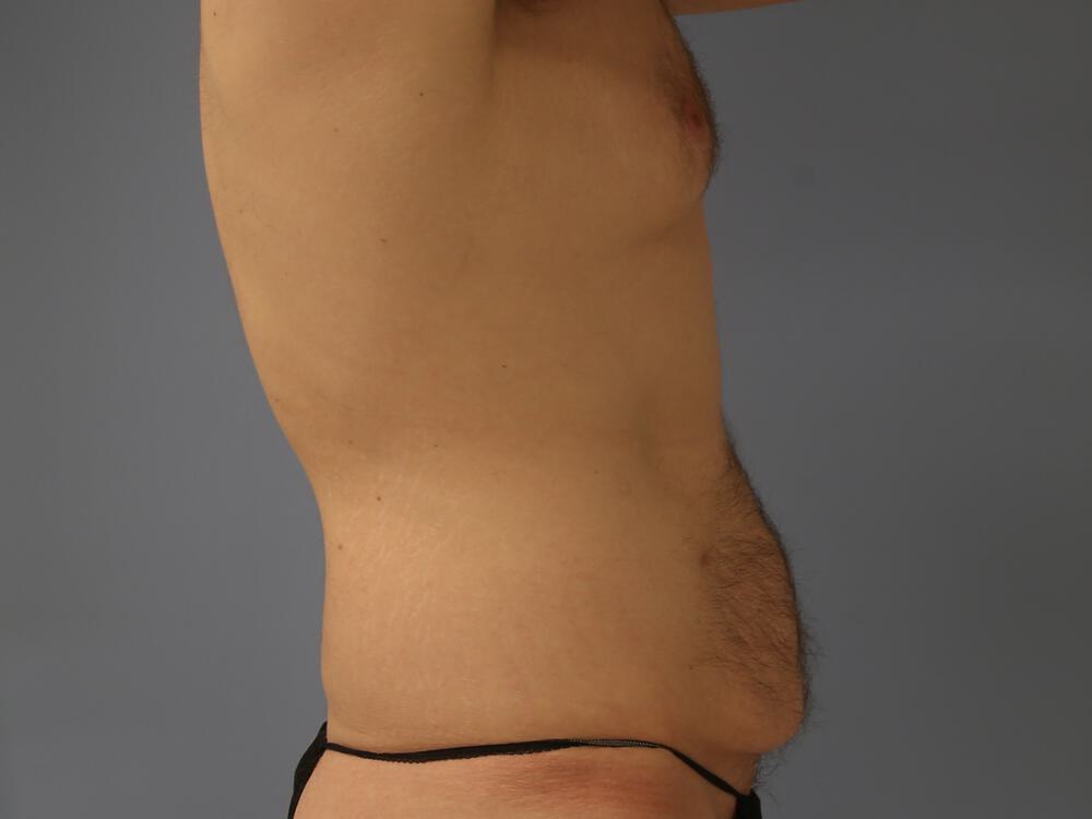 Male tummy tuck Before & After Image