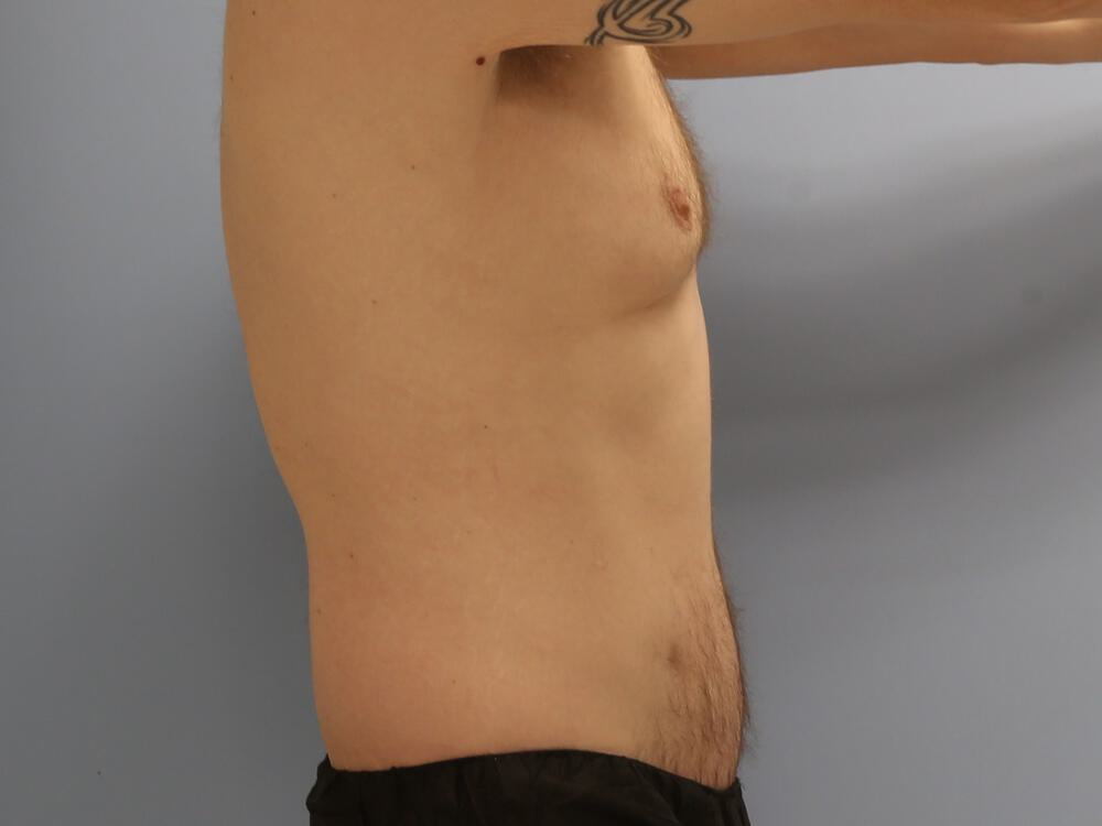 Male tummy tuck Before & After Image