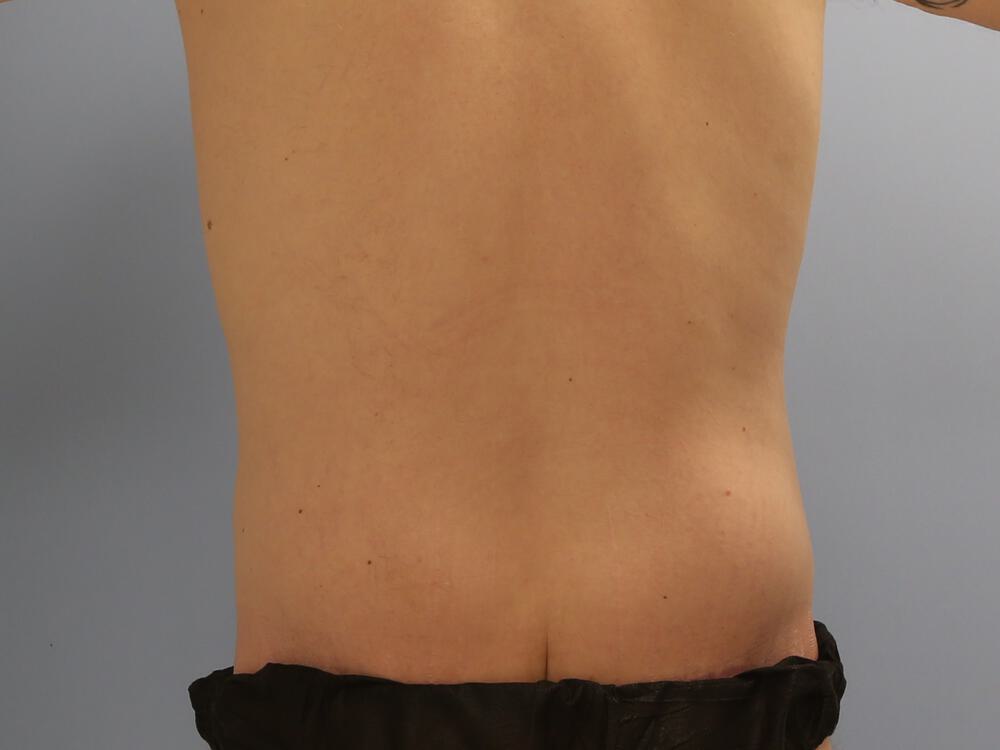 Male Tummy Tuck Before & After Image