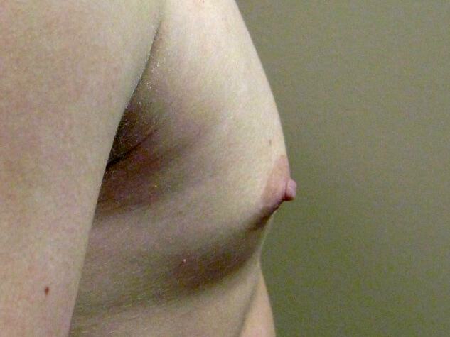 Male Nipple Reduction Before & After Image