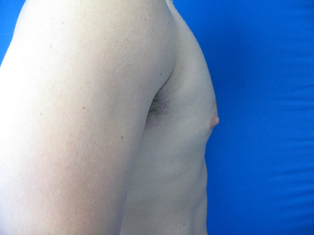 Male Nipple Reduction Before & After Image