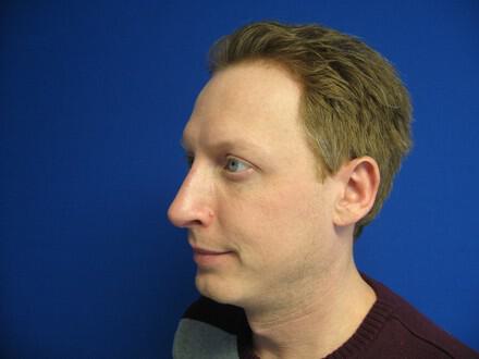 Male Rhinoplasty Before & After Image