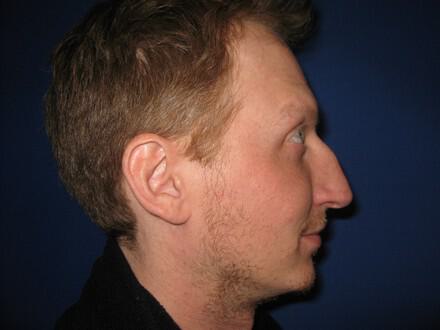 Male Rhinoplasty Before & After Image