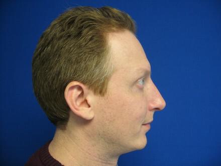 Male Rhinoplasty Before & After Image