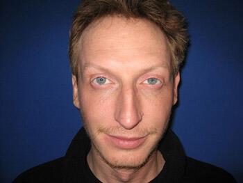 Male Rhinoplasty Before & After Image