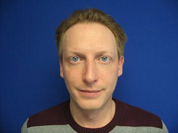 Male Rhinoplasty Before & After Image