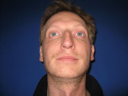 Male Rhinoplasty Before & After Image