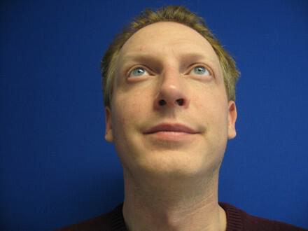 Male Rhinoplasty Before & After Image