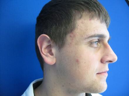 Male Rhinoplasty Before & After Image