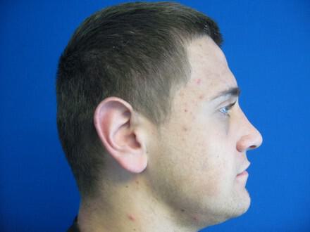 Male Rhinoplasty Before & After Image