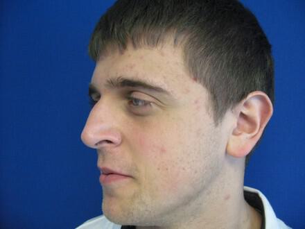 Male Rhinoplasty Before & After Image