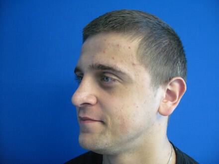 Male Rhinoplasty Before & After Image