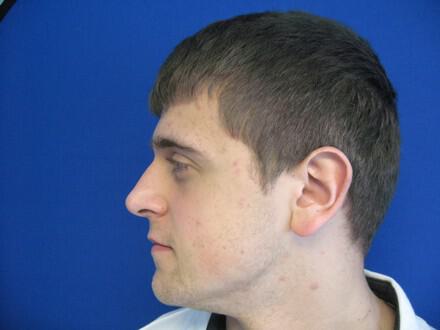Male Rhinoplasty Before & After Image